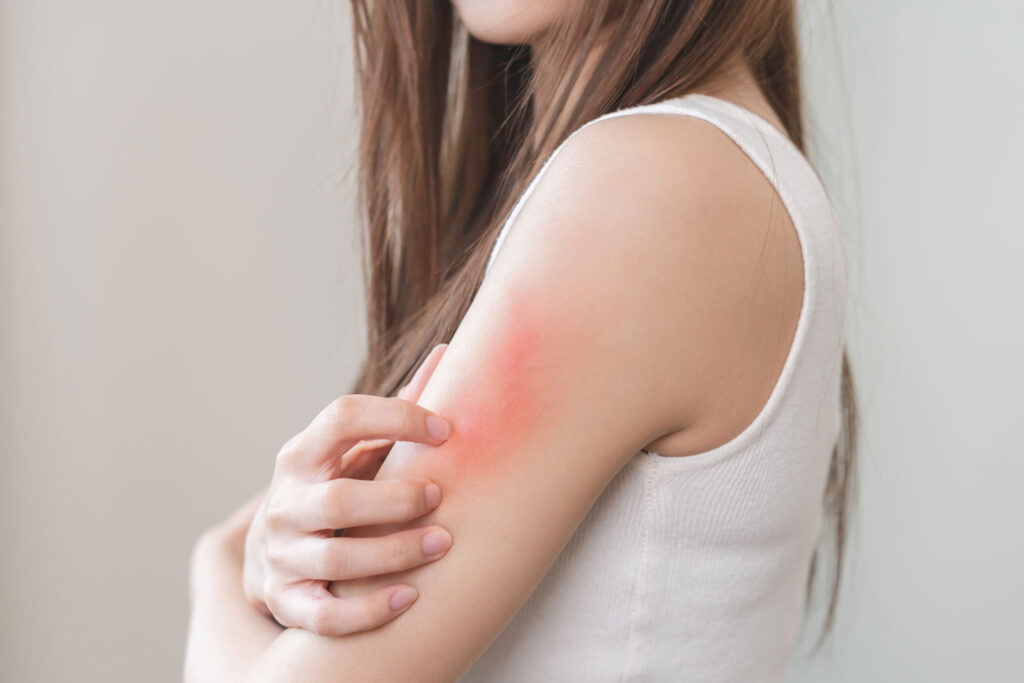 かゆみと炎症反応に関する研究をイメージした皮膚の発赤